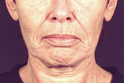 Laser Facial Resurfacing Darmabraision(Before)