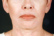 Laser Facial Resurfacing Darmabraision(After)