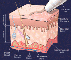 Microdarmabrasion